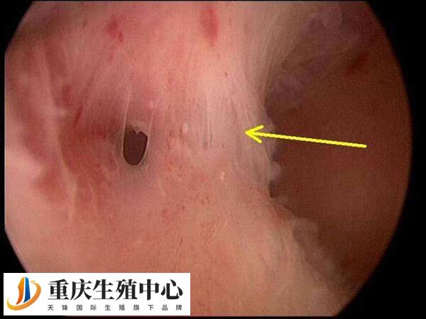 什么情况下会出现宫腔粘连
