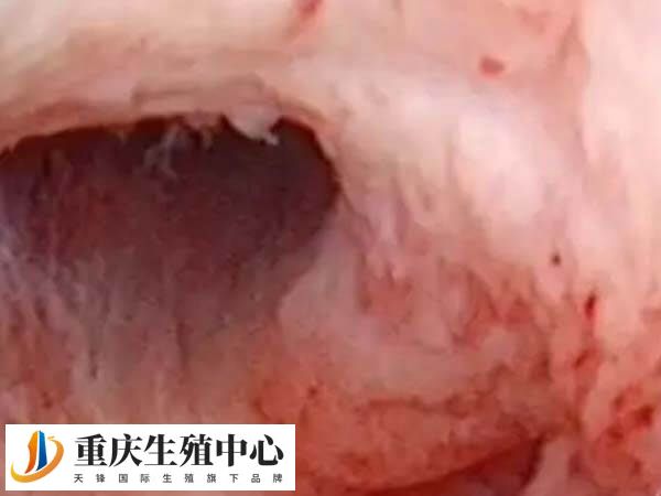宫腔粘连与人流次数无关