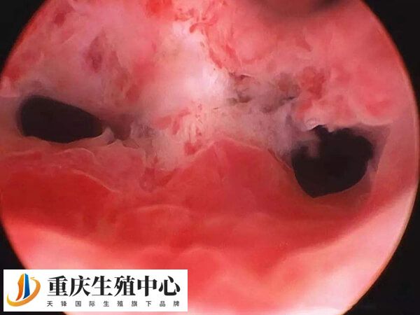 定期进行妇科检查预防宫腔粘连
