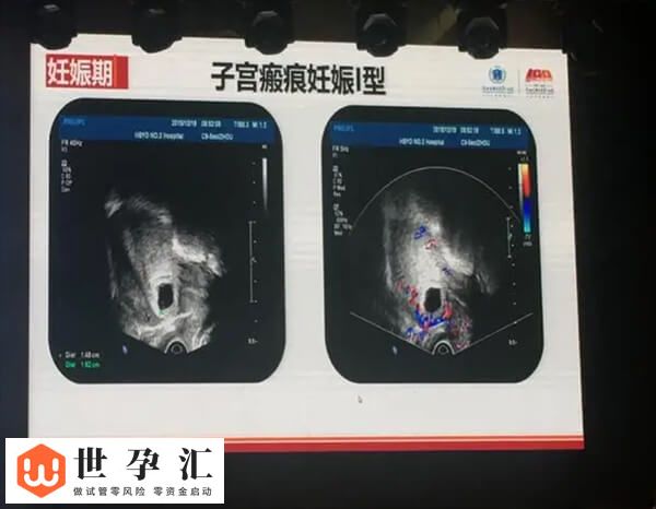 试管可不可以避开子宫疤痕(图2)
